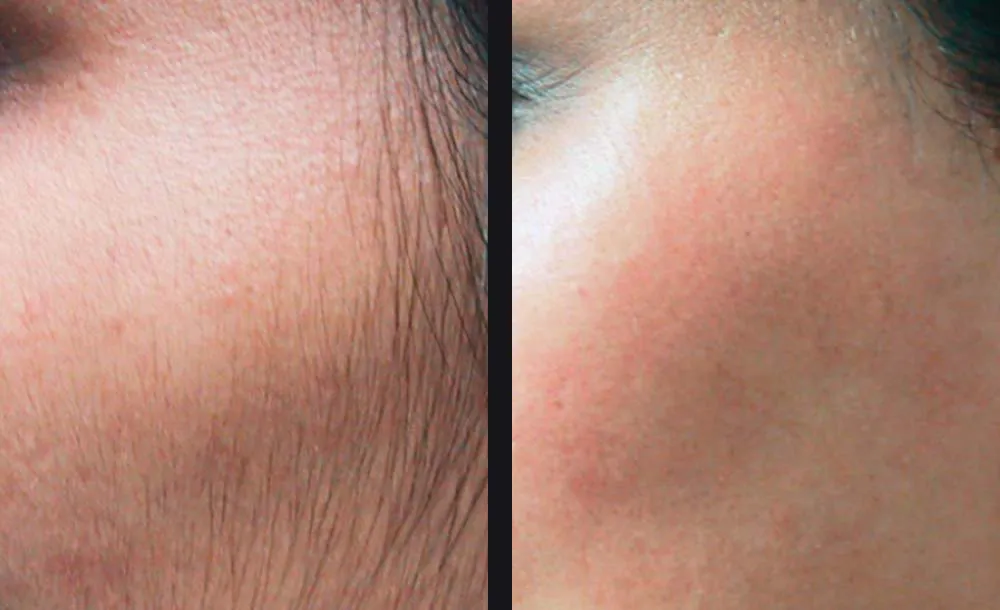 gentle-hair-removal-candela-p1.jpg