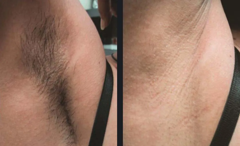 gentle-hair-removal-candela-p2.jpg