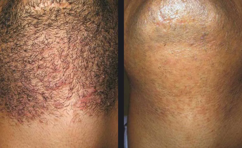 gentle-hair-removal-candela-p3.jpg