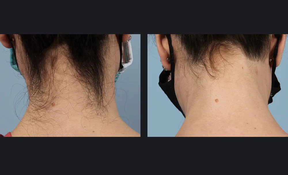 gentlemaxpro-plus-hair-removal-candela-2tx-p1.jpg
