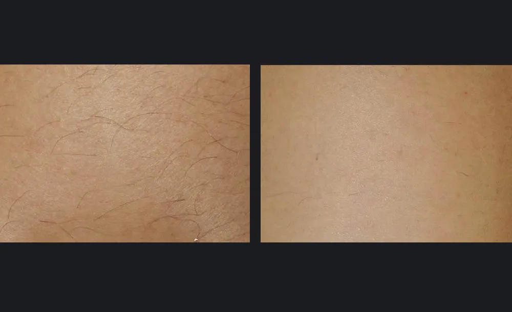 gentlemaxpro-plus-hair-removal-candela-3tx-p2.jpg