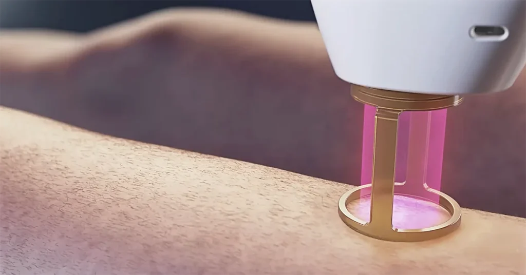 Laser hair removal in Croydon for arms and legs